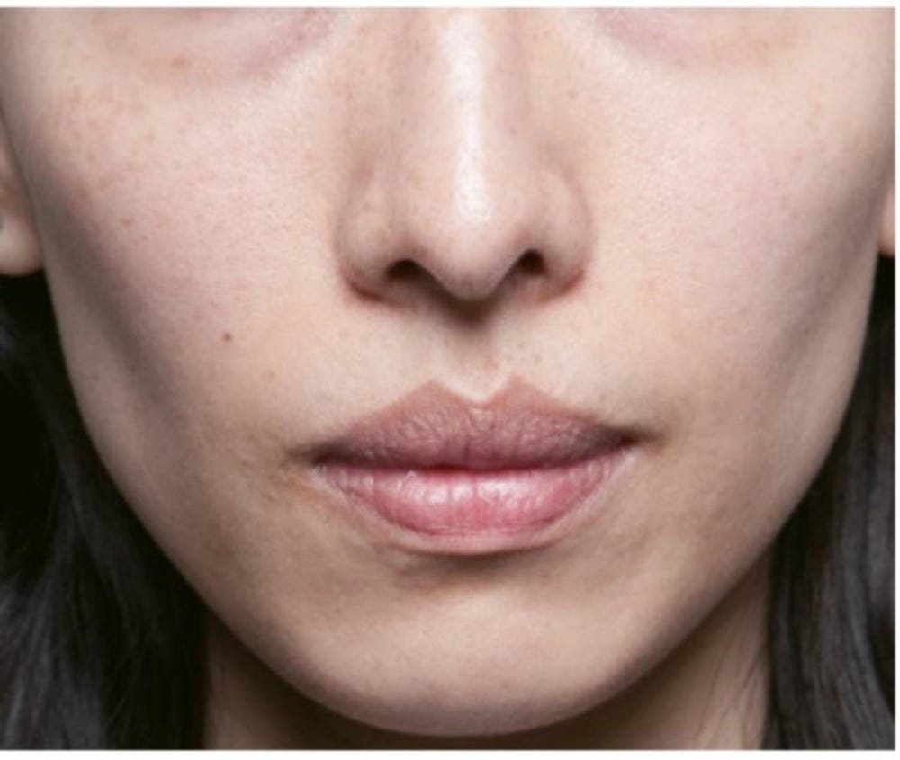 Tại sao sau tiêm botox lại thấy mặt bị hóp — đây có phải biến chứng không?