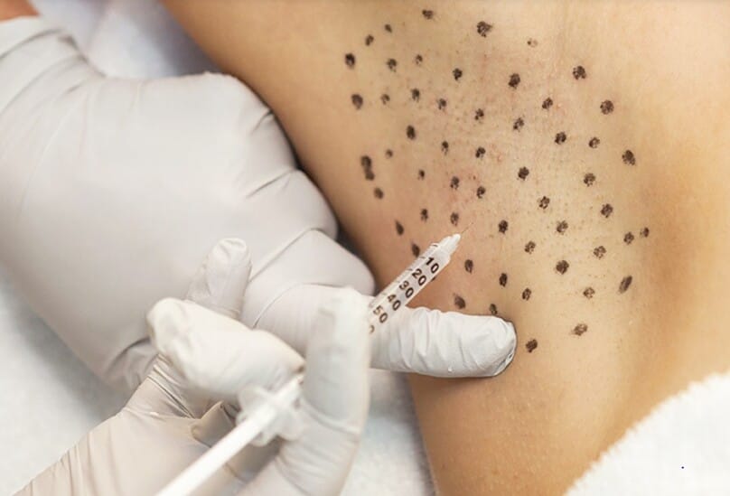 Quy trình tiêm botox ngăn mồ hôi nách diễn ra như thế nào? Trước, trong và sau khi tiêm cần lưu ý gì?