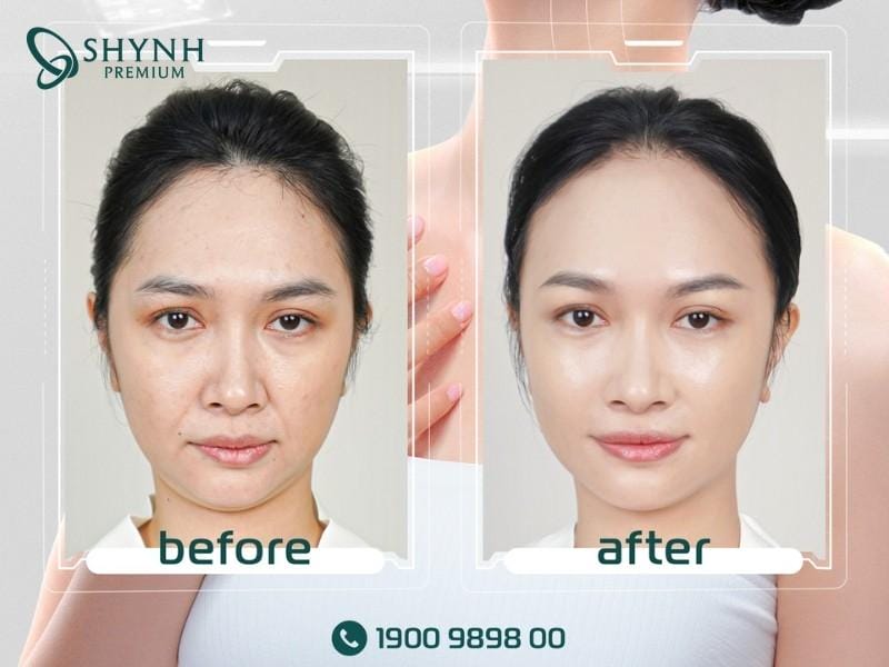 Câu hỏi thường gặp về tiêm botox ngừa lão hóa