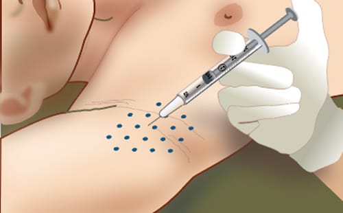 Liều lượng, đơn vị botox U và cách tính chi phí