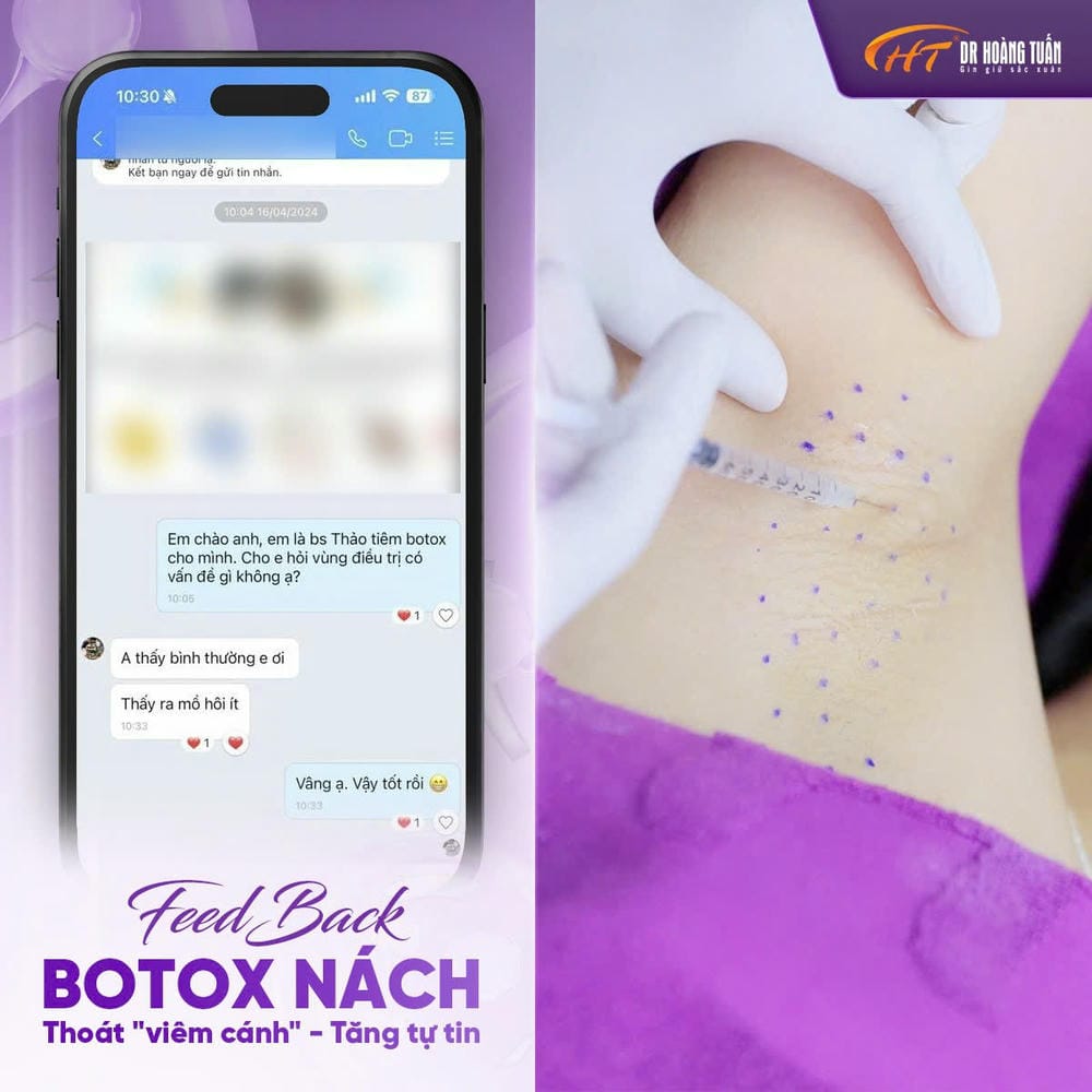 Ai phù hợp/không phù hợp với tiêm botox nách và những lưu ý chăm sóc sau điều trị?