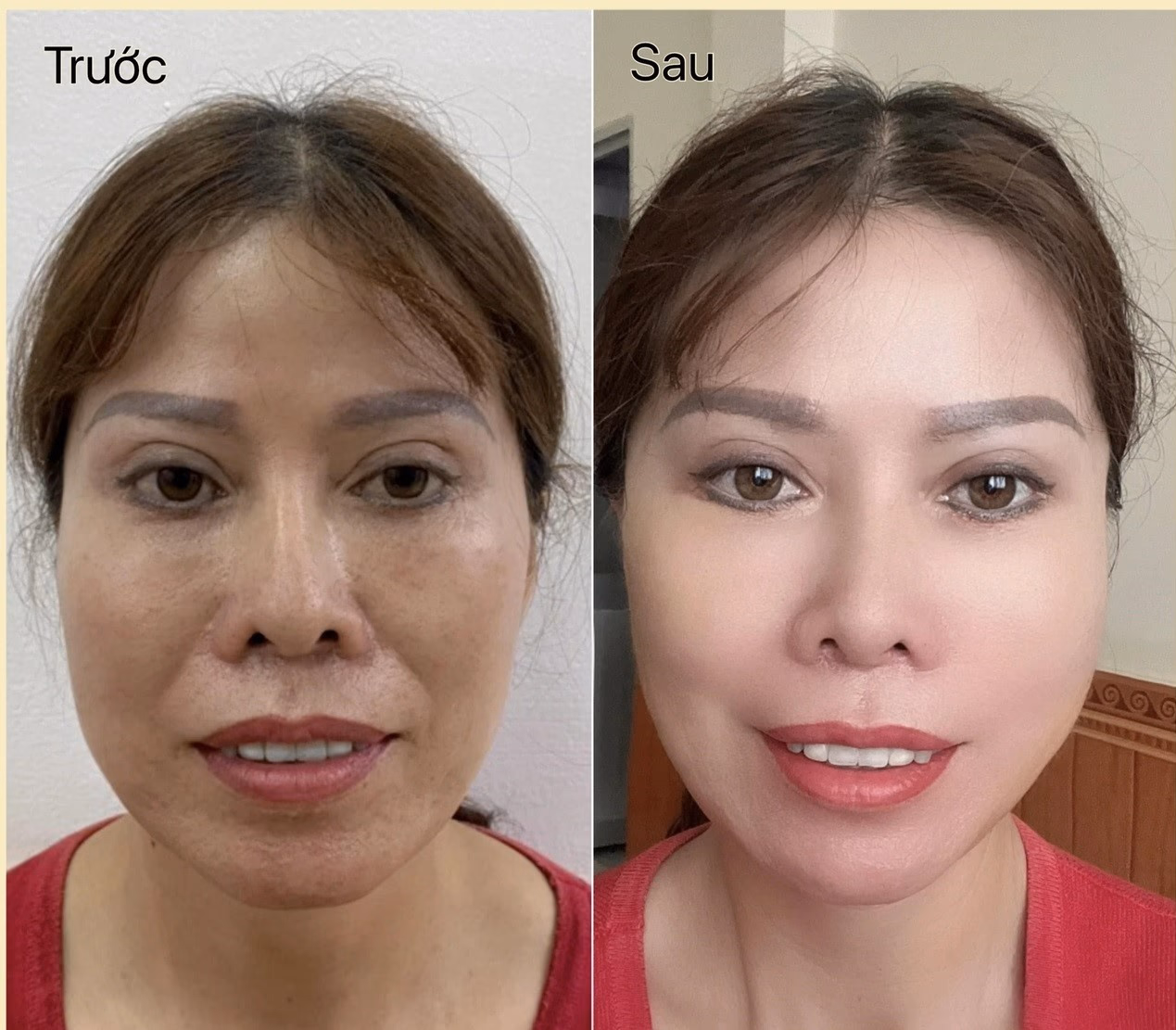 Tiêm botox rãnh cười có tác dụng thế nào — cơ chế ra sao?