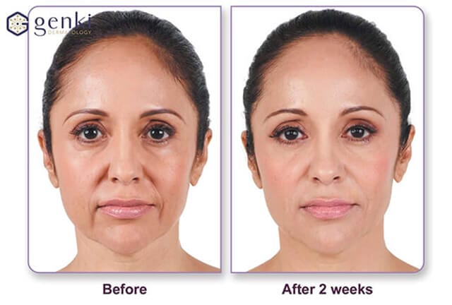 Tiêm botox rãnh cười hay filler rãnh cười — nên chọn cách nào?