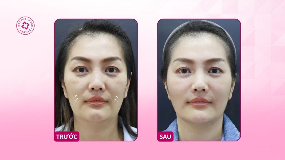 Quy trình tiêm an toàn cho rãnh cười — từng bước với bác sĩ da liễu thẩm mỹ