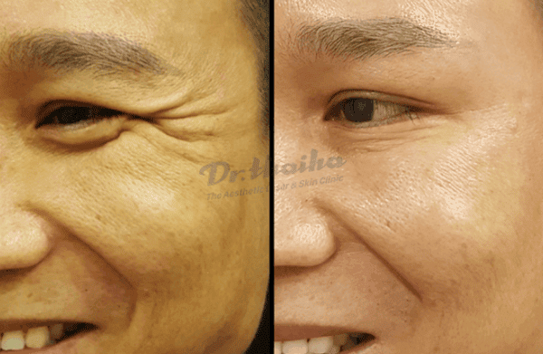 Quy trình tiêm botox cho vùng mắt được thực hiện như thế nào, và an toàn ra sao?