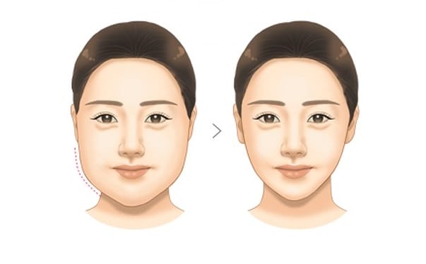 Tiêm botox tan mỡ mặt có rủi ro gì — có nguy hiểm không?
