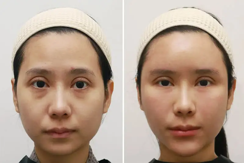 Những lưu ý chuyên môn khi quyết định tiêm