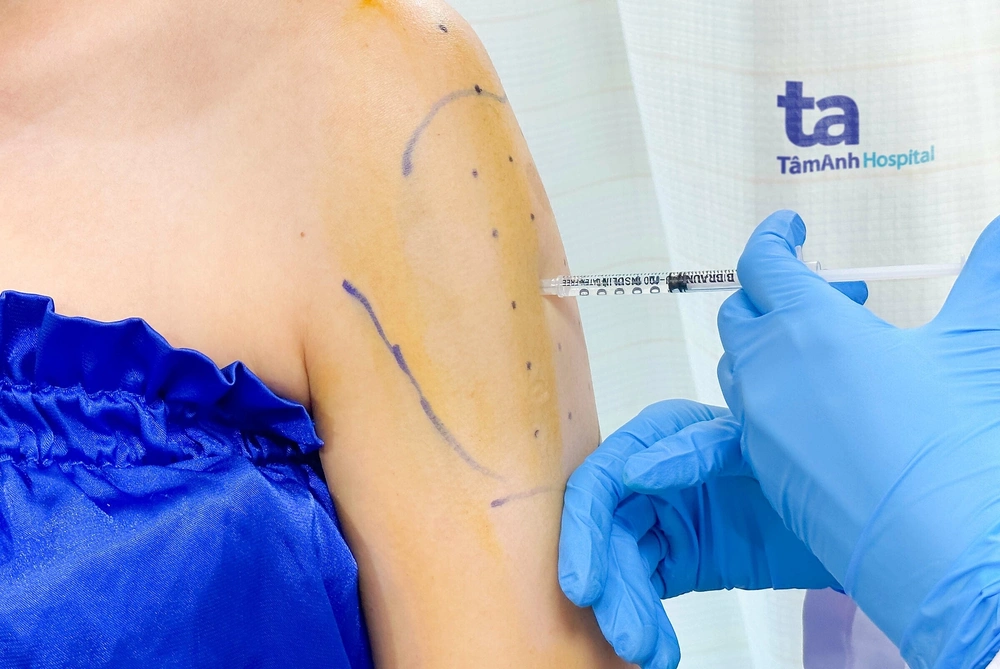 Quy trình tiêm botox thon bắp tay diễn ra như thế nào và lưu ý an toàn tiêm botox?