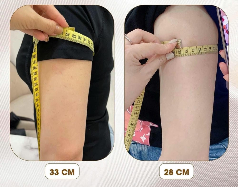Tiêm botox thon bắp tay có thực sự giúp bắp tay thon gọn không?