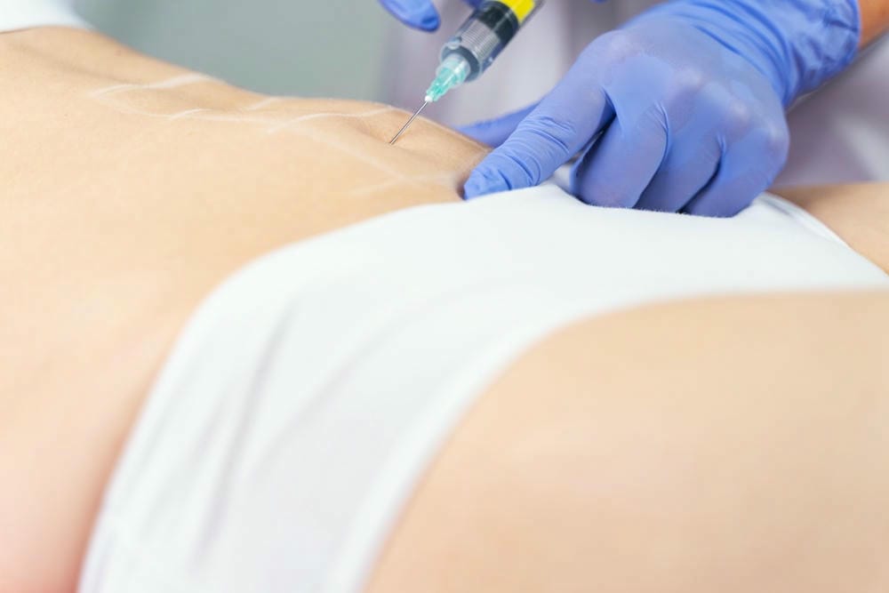 Tiêm botox thon bụng so với hút mỡ bụng, HIFEM và tiêm tan mỡ — khác nhau như thế nào?