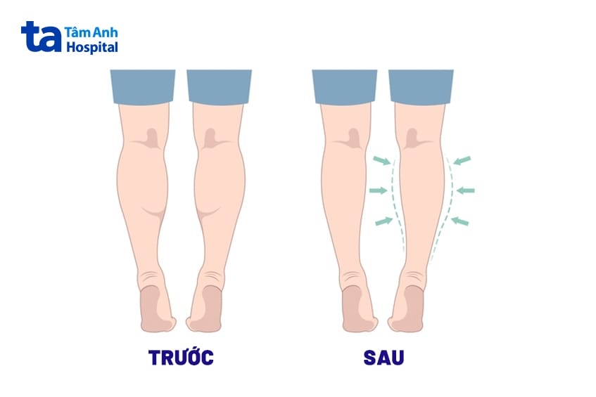 Tiêm botox thon gọn bắp chân an toàn không — biến chứng hay gặp là gì?