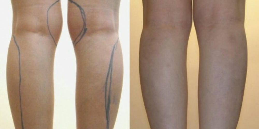 Quy trình tiêm và mốc thời gian thấy kết quả