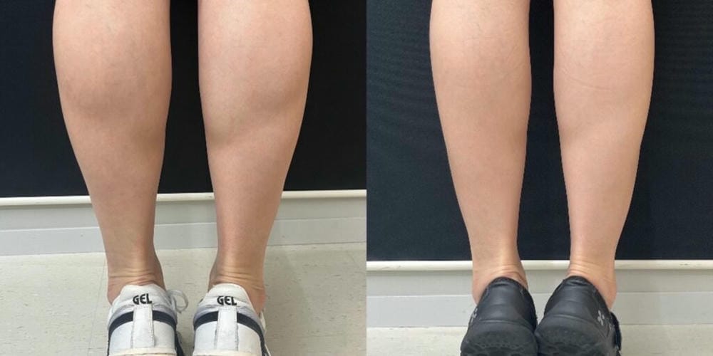 Cách chọn bác sĩ tiêm botox bắp chân an toàn — checklist trước khi quyết định