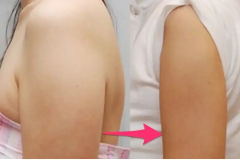Tiêm botox thon gọn bắp tay bao nhiêu tiền ở TP.HCM, Hà Nội và Cần Thơ?