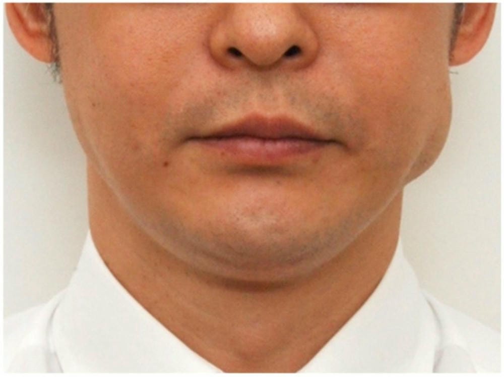 Chọn nơi tiêm: câu hỏi cần đặt ra