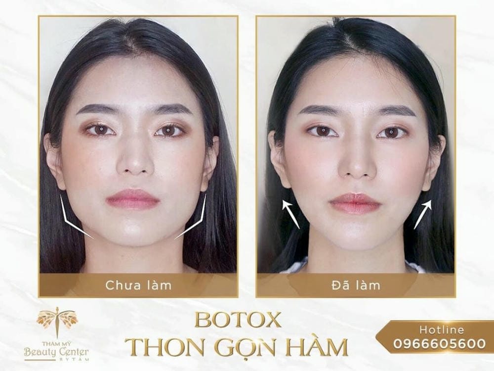 Tiêm Botox thon gọn hàm có đau không và nguyên nhân gây đau là gì?