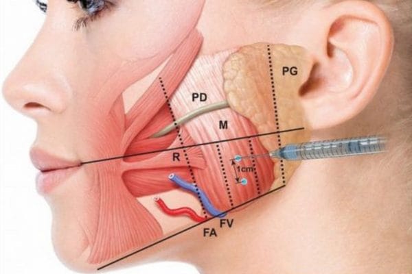 Tiêm Botox có an toàn không — tác dụng phụ botox và biến chứng có thể gặp?