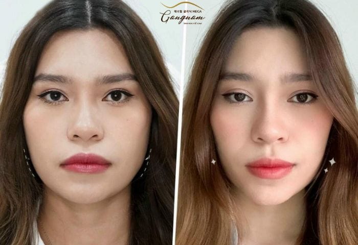 Lựa chọn cơ sở và nhãn hiệu botox: điều cần biết để giảm rủi ro