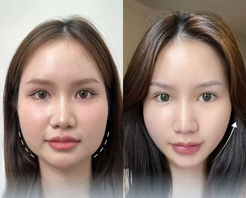 Bao nhiêu liều là đủ khi tiêm Botox cơ cắn và nhãn hàng cần biết?