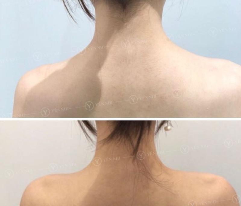 Liều lượng botox và kỹ thuật tiêm cơ thang — có con số cố định không?