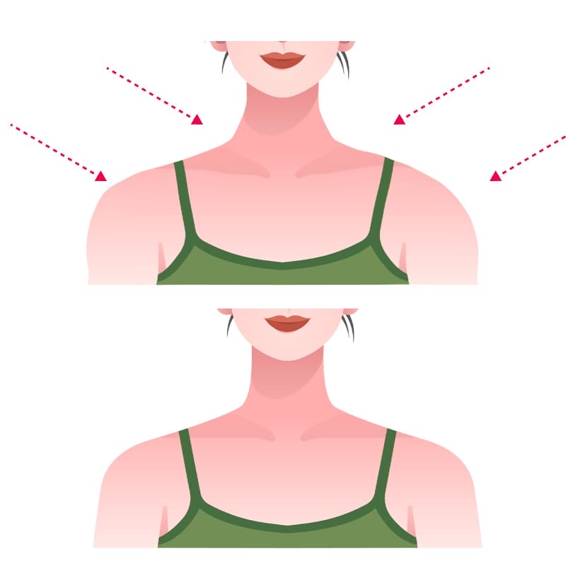 Tiêm botox thon gọn vai có nguy hiểm không — tác dụng phụ botox thường gặp là gì?