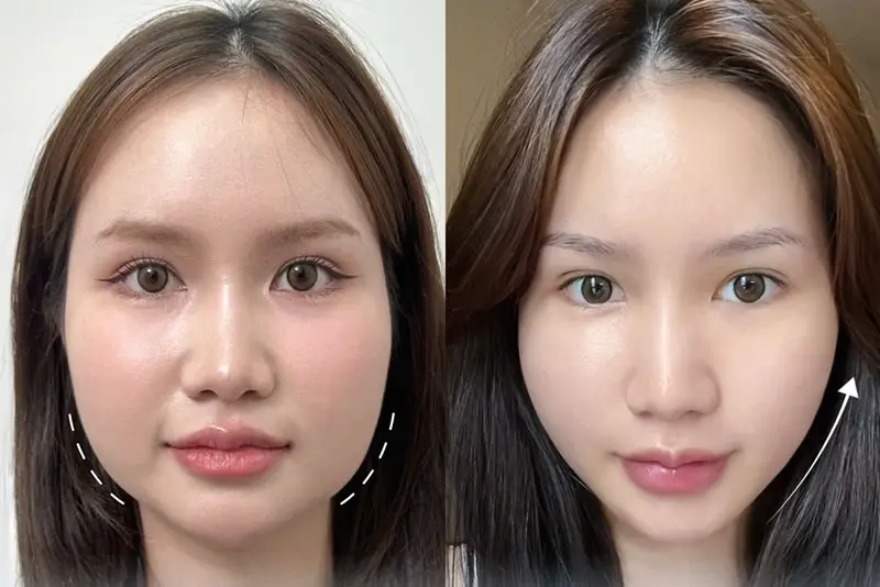 Liều lượng và cách tiêm cho an toàn