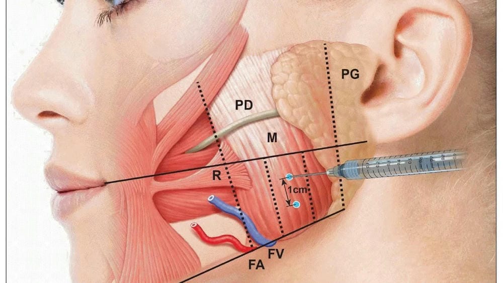 Những vùng nào thường tiêm botox vào cơ và mục tiêu điều trị là gì?