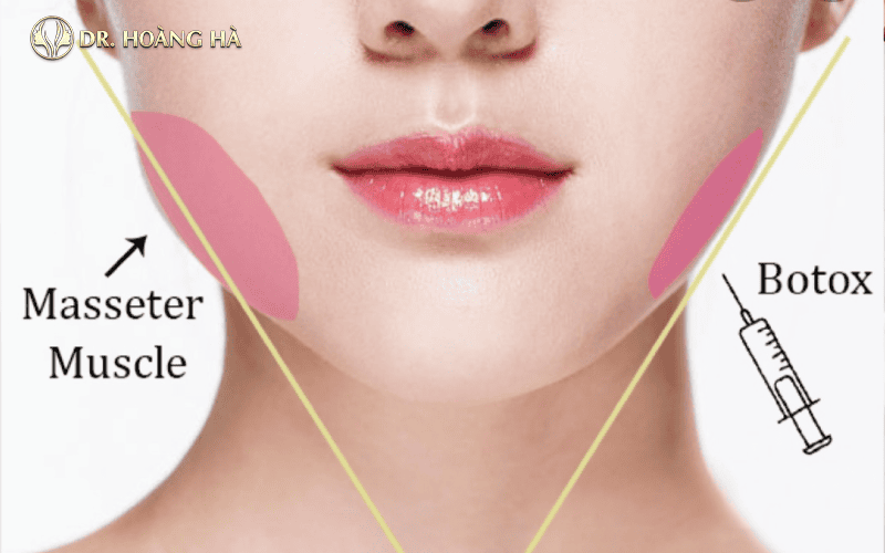 Những rủi ro và biến chứng botox cần biết trước khi tiêm