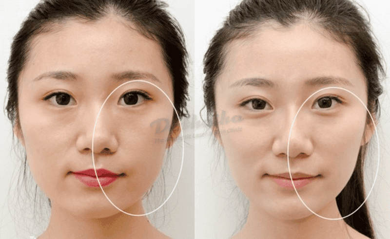 Các chế phẩm botulinum toxin type A được phép tại Việt Nam và cách chọn sản phẩm?