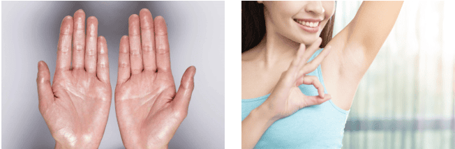 Ai phù hợp và ai không nên tiêm botox cho tình trạng tăng tiết mồ hôi?