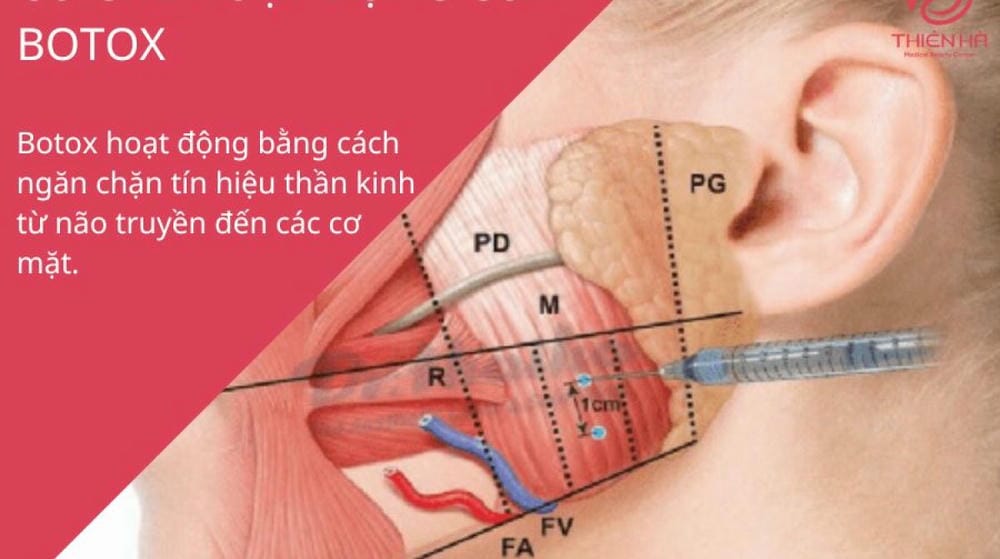 Quy trình tiêm botox chuẩn y khoa — cần hỏi gì trước khi đồng ý?