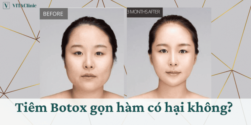 Thời gian duy trì Botulax và lịch nhắc lại — làm sao biết đã tới thời điểm tái tiêm?