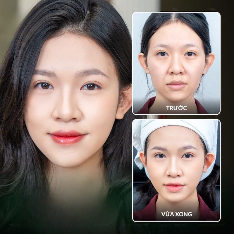 Nếu gặp tình huống tắc mạch do HA thì xử trí như thế nào và hyaluronidase đóng vai trò ra sao?