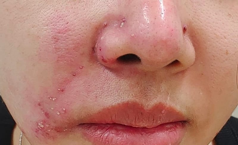 Làm sao để giảm tối đa rủi ro — tiêu chí chọn nơi tiêm và bác sĩ?