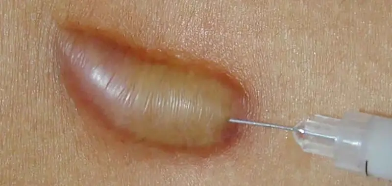 Tiêm corticoid đơn lẻ hay nên kết hợp với phương pháp khác?