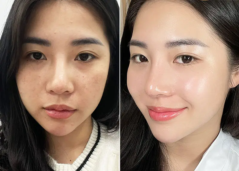 Loại nào tốt hơn cho mục tiêu căng bóng và trẻ hóa da — HA, PDRN, PRP hay exosome?