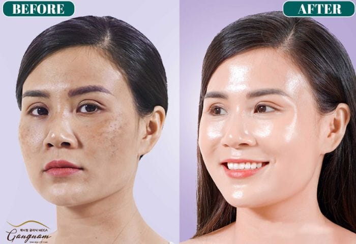 Làm sao để chọn nơi thực hiện tiêm căng bóng an toàn và hiệu quả?
