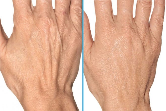 Loại filler nào phù hợp cho bàn tay — Hyaluronic Acid (HA) hay CaHA (Radiesse) — và vì sao?
