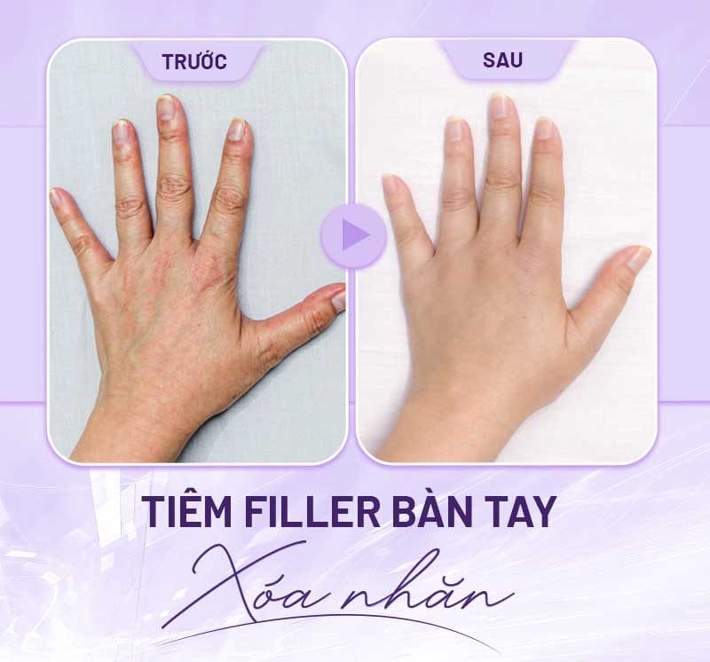 Khi nào KHÔNG nên tiêm filler bàn tay — các chống chỉ định phổ biến?