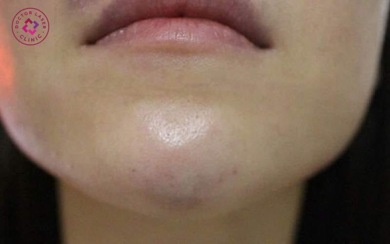 Quy trình can thiệp thường thấy khi có biến chứng nặng