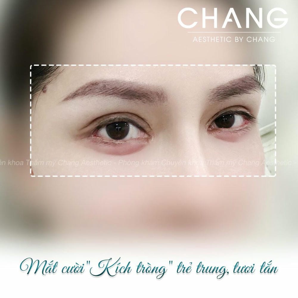 So sánh: Tiêm filler bọng mắt và phẫu thuật lấy mỡ (blepharoplasty) — chọn phương án nào?