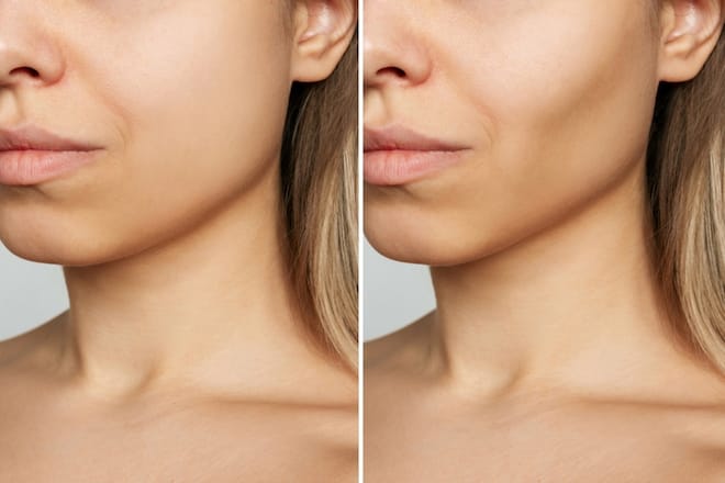 So sánh tiêm filler và cấy mỡ tự thân cho má hóp — lựa chọn nào bền hơn và phù hợp với ai?