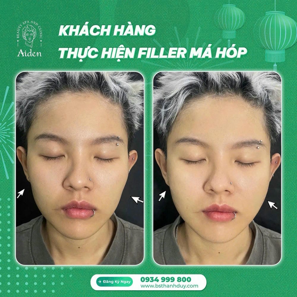 Bằng chứng lâm sàng và dữ liệu hỗ trợ — có nghiên cứu nào về filler vùng má?