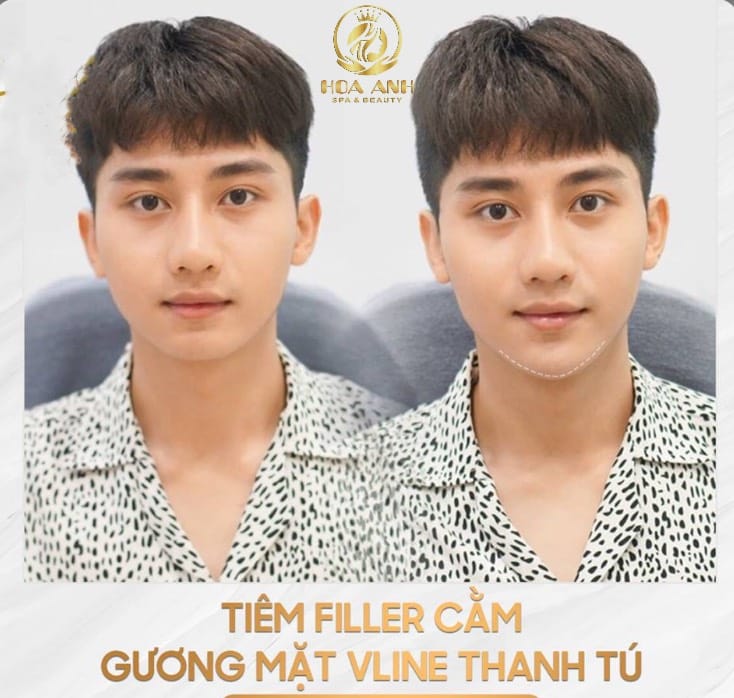 Lựa chọn filler theo vùng và mục tiêu của nam giới — ví dụ thực tế