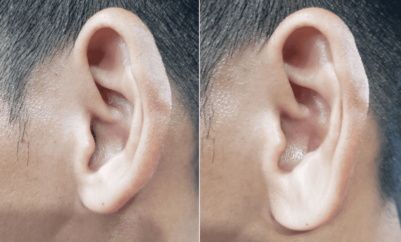 Chăm sóc sau tiêm và kỳ vọng về kết quả