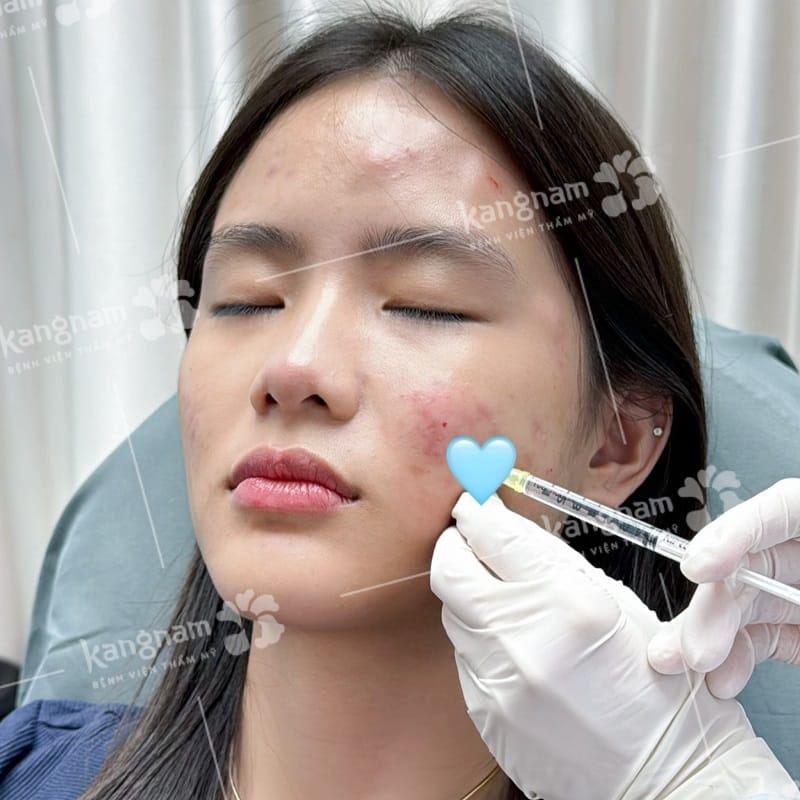 Biến chứng tiêm filler: từ nhẹ đến nguy hiểm, xuất hiện khi nào?