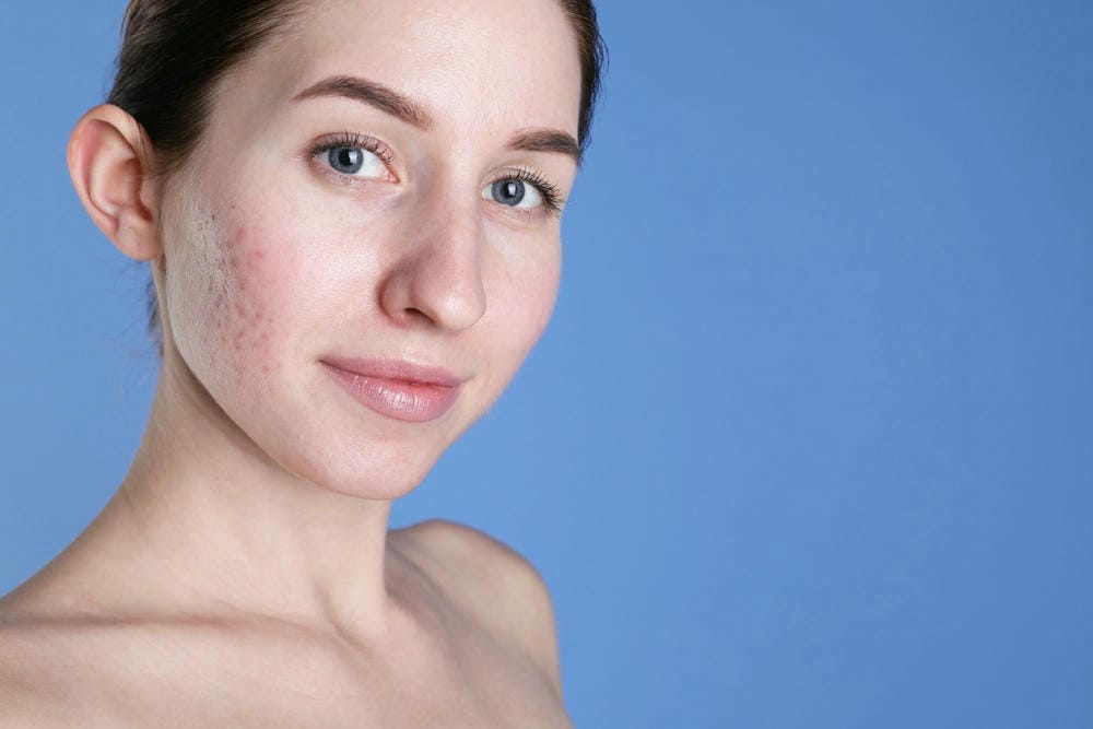 Điền thể tích và kích thích collagen