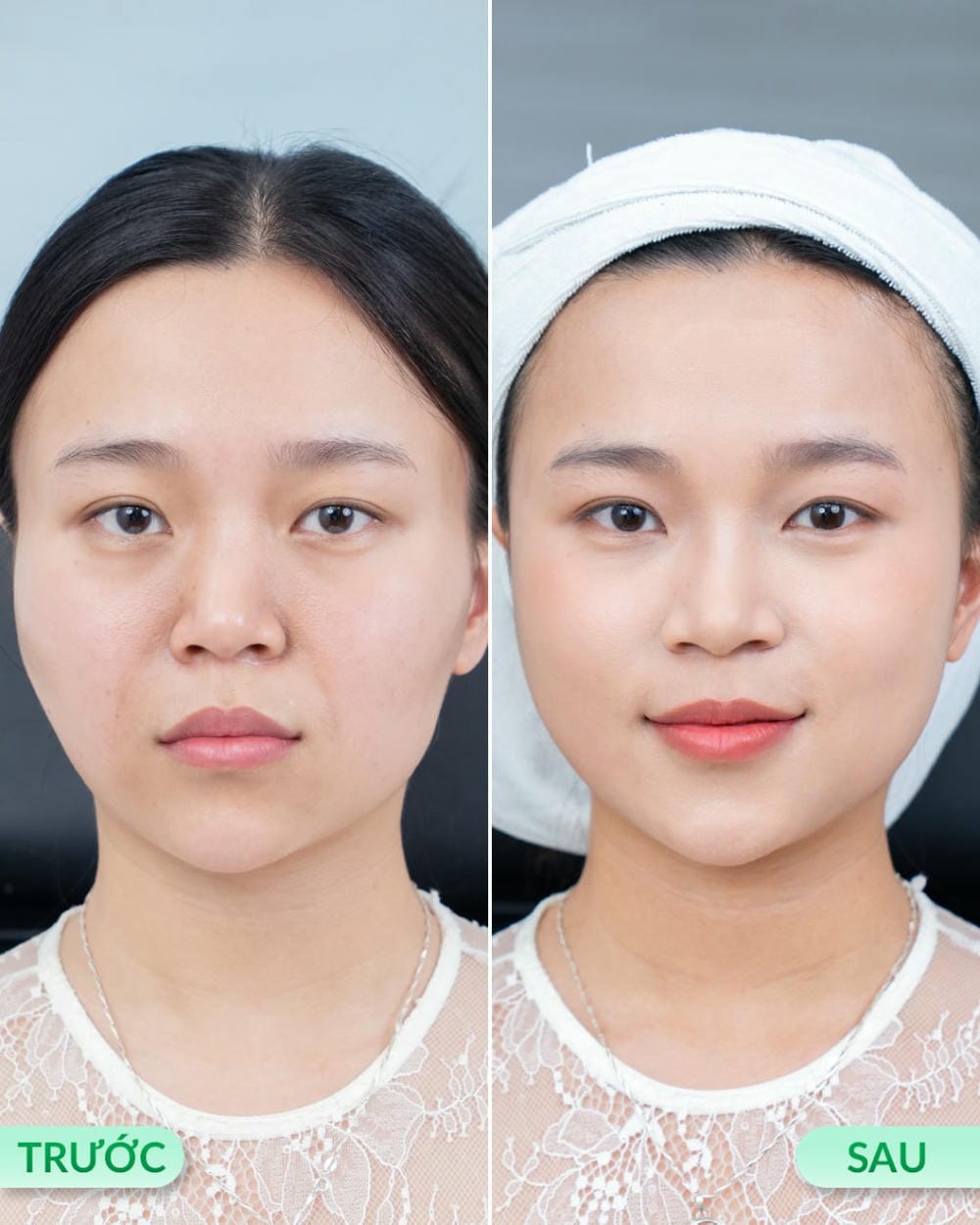 Nếu tiêm filler không đúng cách, những rủi ro nào có thể xảy ra?