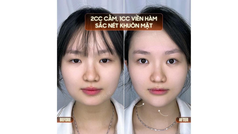 Tiêu chí chọn cơ sở và bác sĩ để tiêm filler an toàn