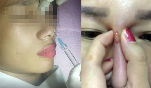 Quy trình chăm sóc sau tiêm filler — những điều nên và không nên làm